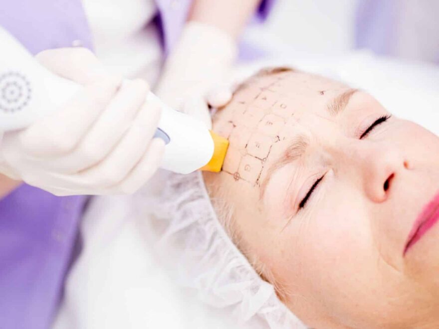 Thermage kezelés az Apollon Beauty szépségszalon Debreceni szalonjában